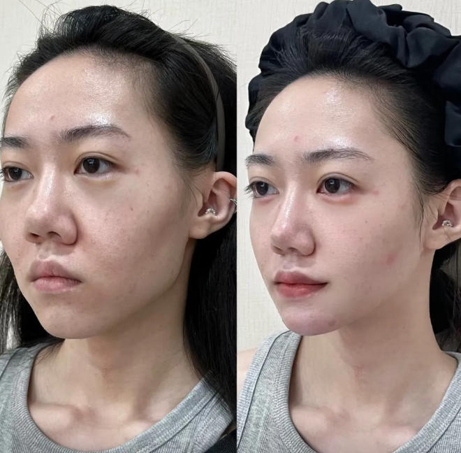 RF microneedling collagen remodeling